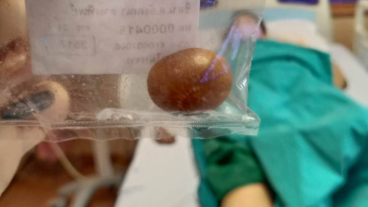 สาวผ่าตัด “นิ่วในถุงน้ำดี” เตือนสายบุฟเฟต์ อร่อยตอนกินแต่มีผลข้างเคียง