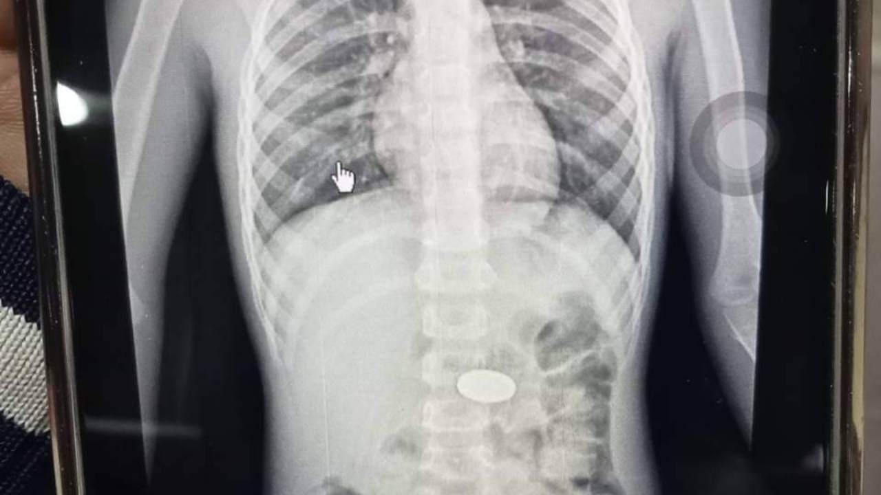 แม่เล่าอุทาหรณ์ ลูกชายอมเหรียญ 5 แล้วพลาดลงคอ เอกซเรย์พบอยู่ในหลอดอาหาร