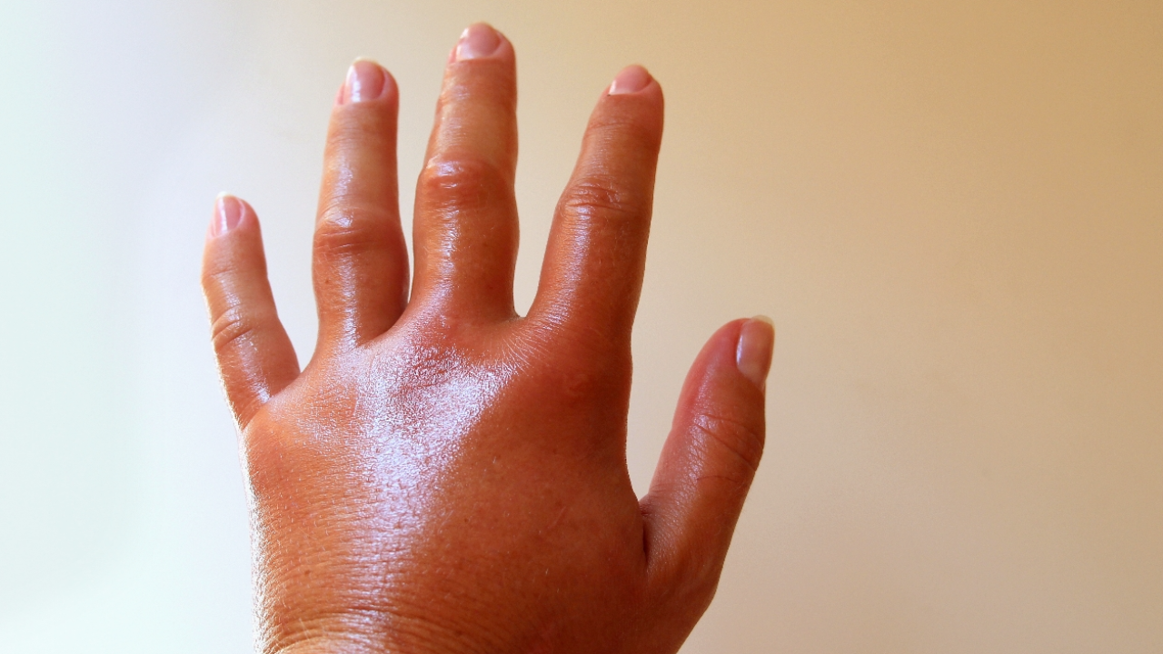 เพจดังให้ความรู้ "ติดเชื้อในชั้นผิวหนัง" มือบวม รักษาไม่ถูกเสี่ยงเน่า