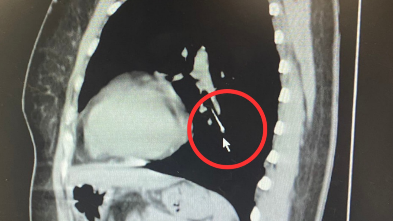 "คาบเข็มหมุด" ขณะเย็บผ้า เกิดสำลักลงหลอดลม แพทย์ต้องช่วยคีบออก