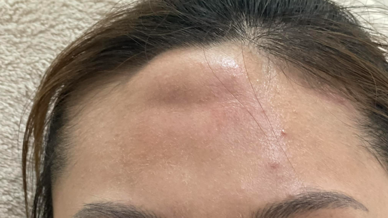 อุทาหรณ์ฉีดฟิลเลอร์กับหมอเถื่อน สาวได้ของแถมเป็นก้อนบวมโตที่หน้าผาก