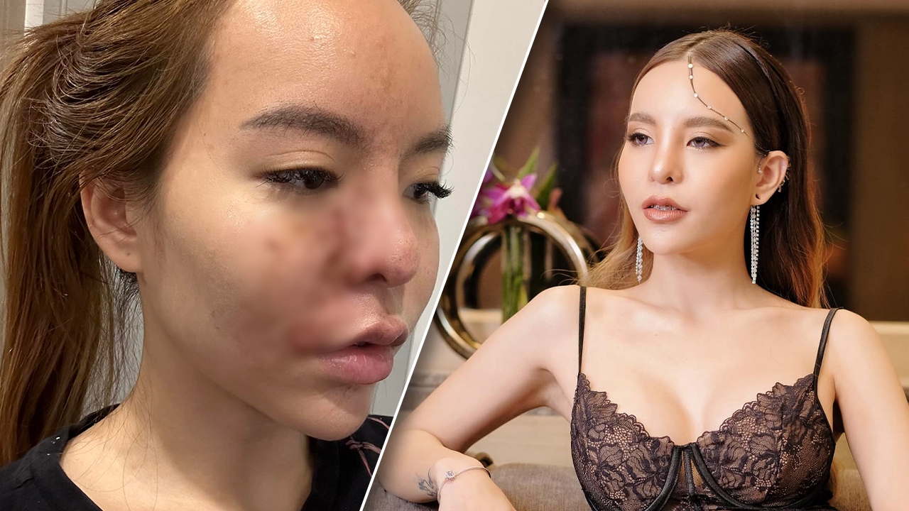 "มะลิ" สาวสวยคนดังแชร์อุทาหรณ์ "ฉีดฟิลเลอร์เข้าเส้นเลือด" จนตาหวิดบอด