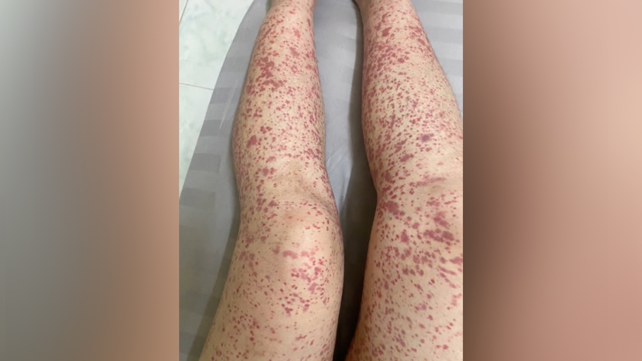 สาวแชร์ประสบการณ์ "เส้นเลือดอักเสบ" เผยภาพขาเป็นจ้ำแดงน่ากลัว 