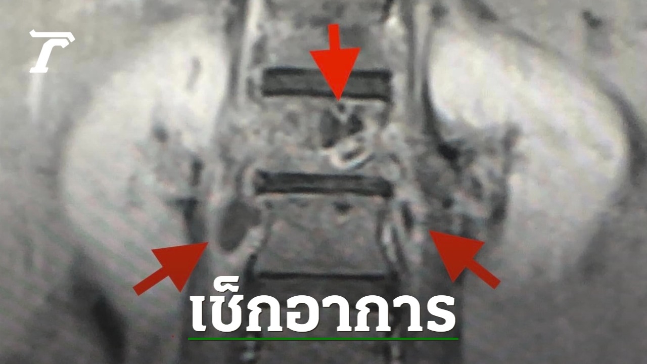 Tuberculosis of the spine diagnosed in a 29-year-old woman experiencing low back pain and difficulty bending.