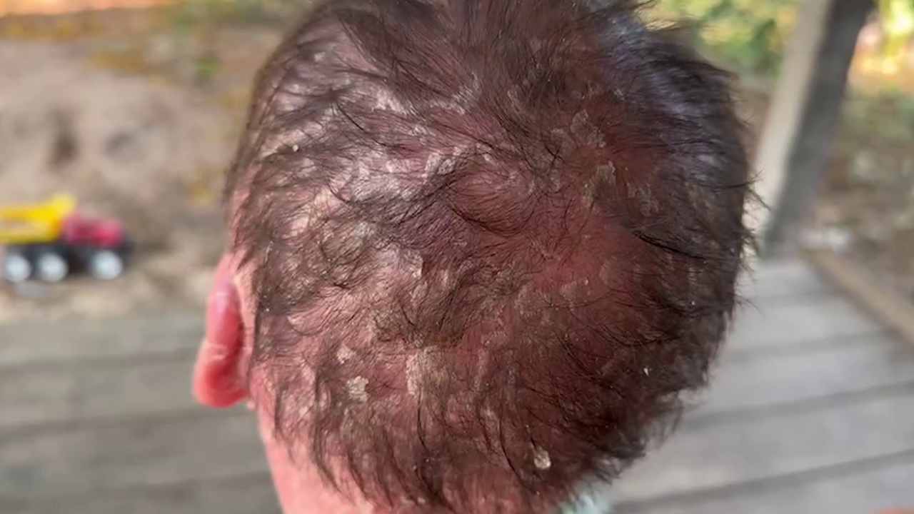 สุดเวทนาหนูน้อย 3 ขวบ ป่วย “สะเก็ดเงิน” ผิวหนังลอก หน้าร้อนแสนทรมาน