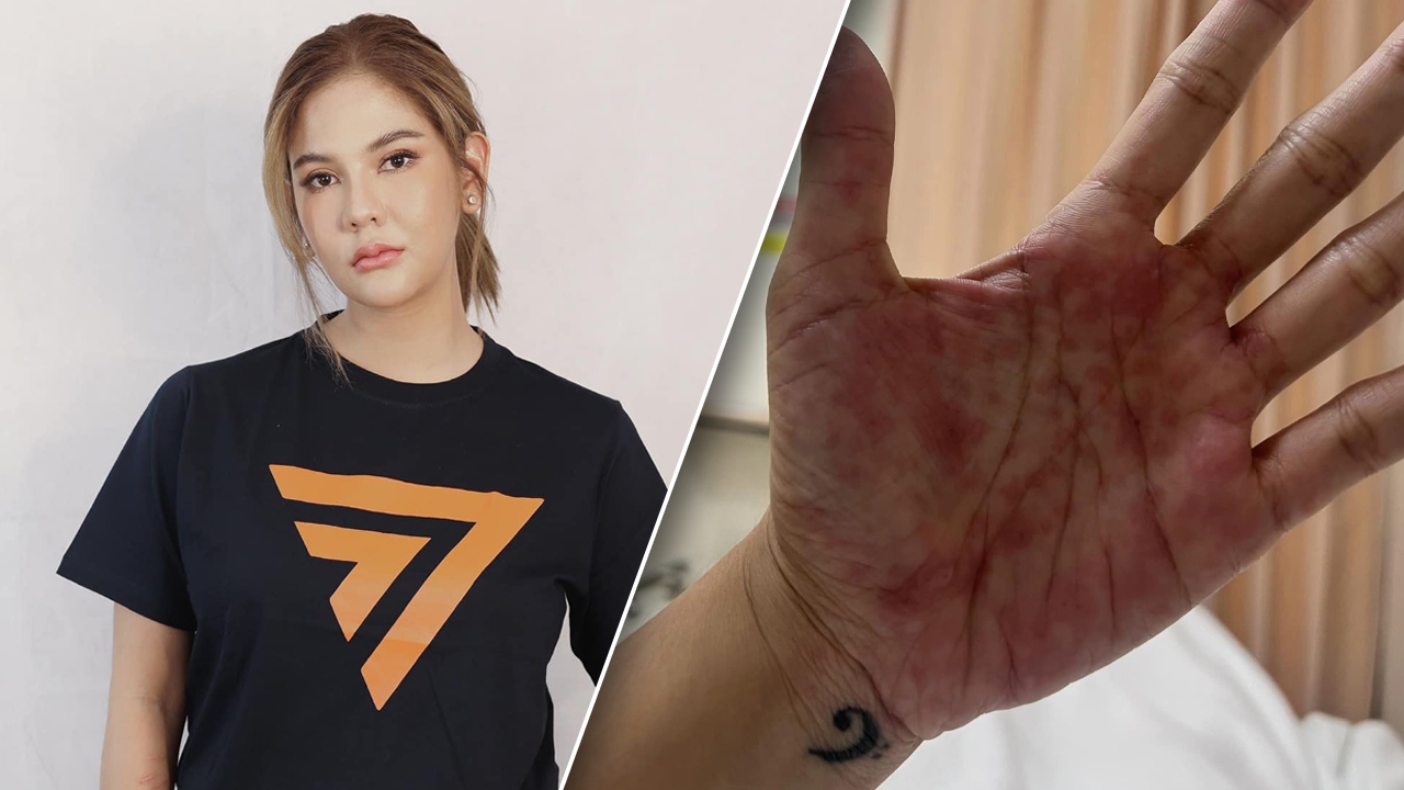 หมิว สิริลภัส แอดมิต รพ. หลังมีอาการผื่นขึ้นรุนแรง ไม่สามารถเดินได้
