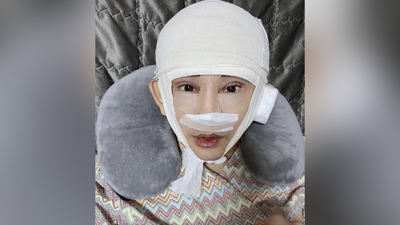 เปิดหน้าล่าสุด พจน์ อานนท์ หลังศัลยกรรมครบ 6 เดือน หล่อมากนึกว่าพระเอกเกาหลี