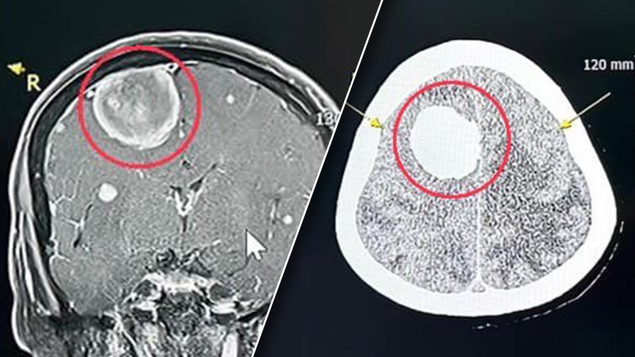 แพทย์เตือนอย่าชะล่าใจ ปวดหัวต่อเนื่อง รุนแรงขึ้น อาจป่วยเนื้องอกเยื่อหุ้มสมอง