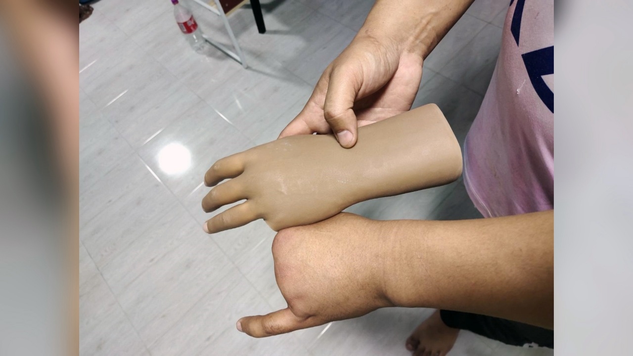 สาวสุดช้ำ เสียเงิน 30,000 บาท สั่งทำ "นิ้วเทียม" ให้สามี แต่ได้สินค้าไม่ตรงปก