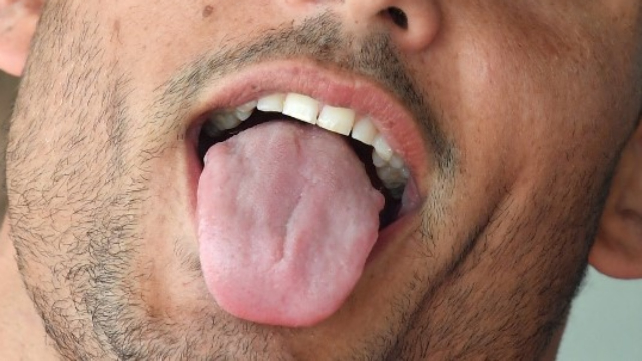 หญิงฝรั่งเศสใจเด็ด กัดลิ้นคนร้ายหื่นส่งเป็นหลักฐานตร.