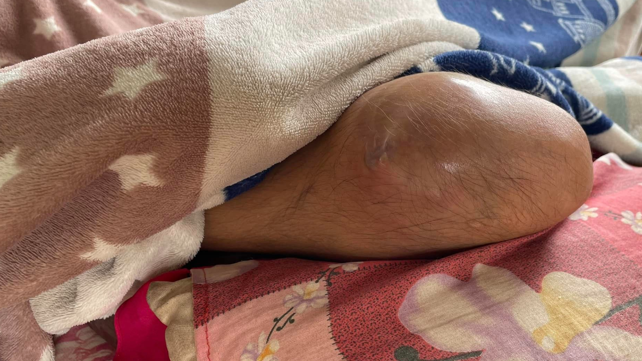 สุดสงสาร เด็กหญิงวัย 14 ปี ยากจน ป่วยมะเร็งกระดูก ร้องไห้ด้วยความเจ็บปวด