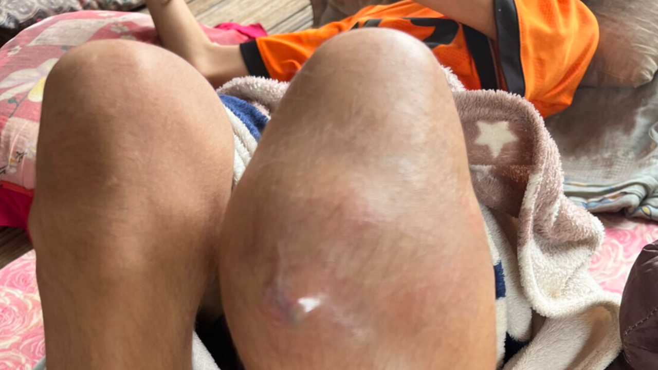 ยอดบริจาคทะลุ 1.4 ล้าน แม่ขอปิดบัญชีช่วยเด็กหญิงวัย 14 ป่วยมะเร็งกระดูก