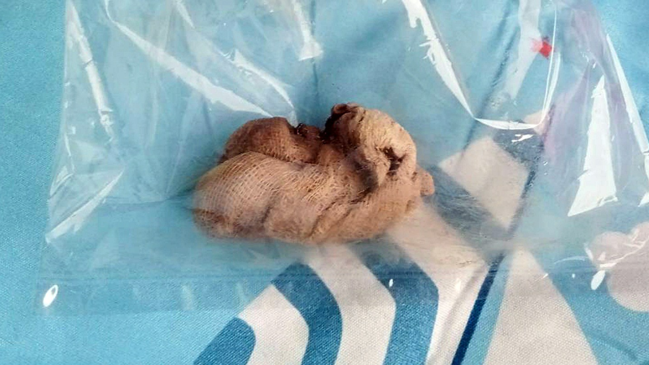 ปวดท้องเกือบเดือน แม่ลูกอ่อนสุดช็อก เจอ "ผ้าก๊อซ" ในช่องคลอด 