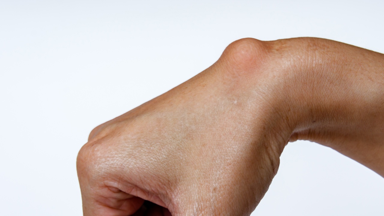 ไขข้อข้องใจ! ชาเลนจ์ทุบ “ถุงน้ำในข้อมือ” ใน Social Media อันตรายไหม