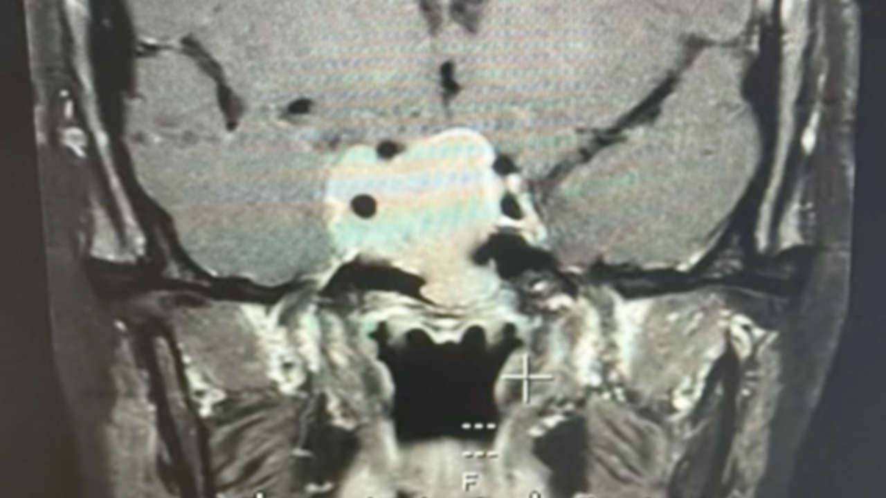 สาวเตือนภัย ประจำเดือนไม่มา สุดท้ายไปตรวจพบ "เนื้องอกต่อมใต้สมอง"