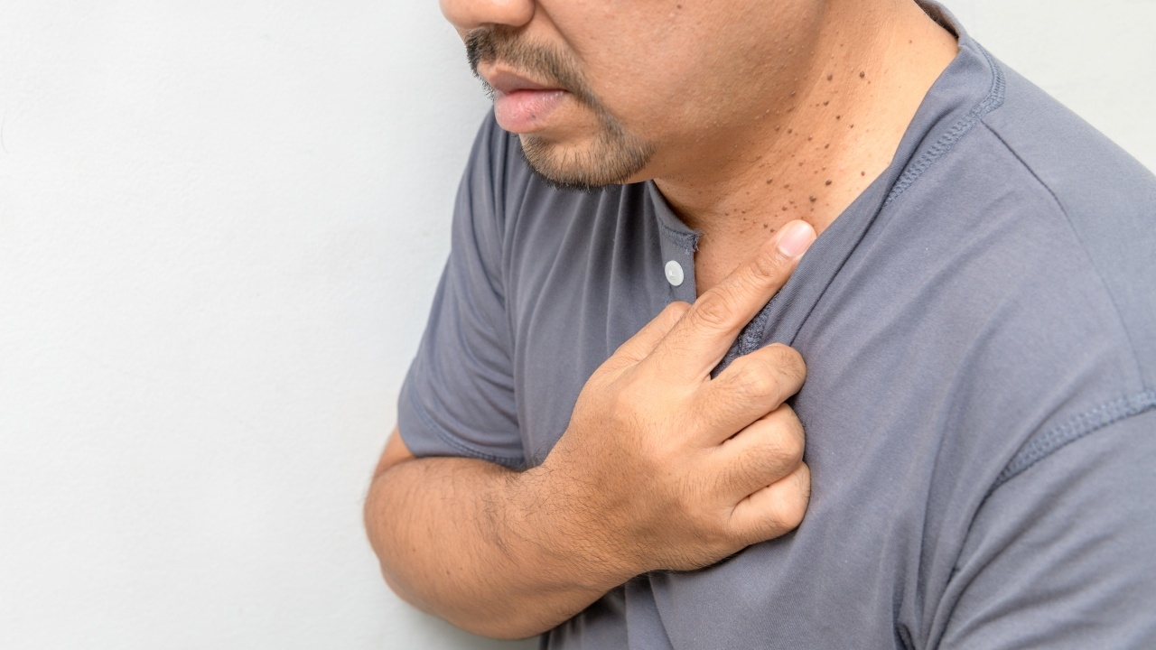 อย่าละเลย "ติ่งเนื้อ" ที่คอ แพทย์เผยเป็นสัญญาณเตือน "ภาวะดื้ออินซูลิน"