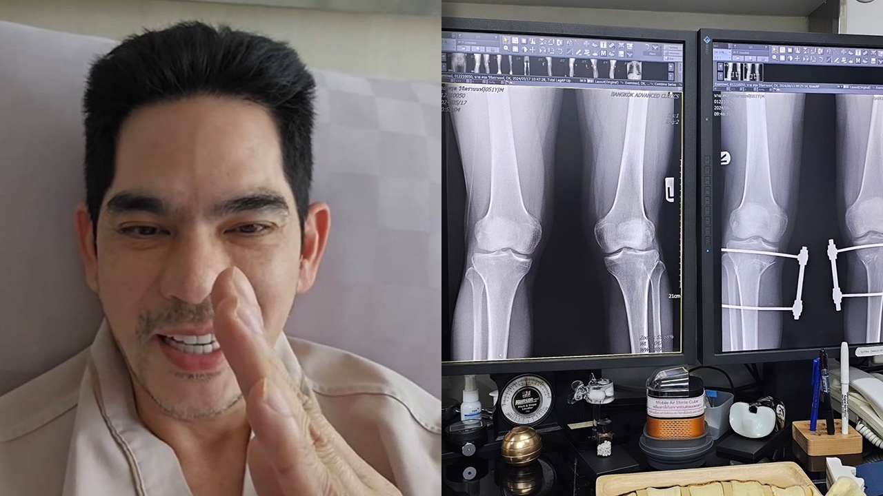 ดาราหนุ่ม โพสต์ผลเอกซเรย์ผ่าตัดขา อธิบายขาฉิ่งคืออะไร ทั้งเจ็บและทรมาน
