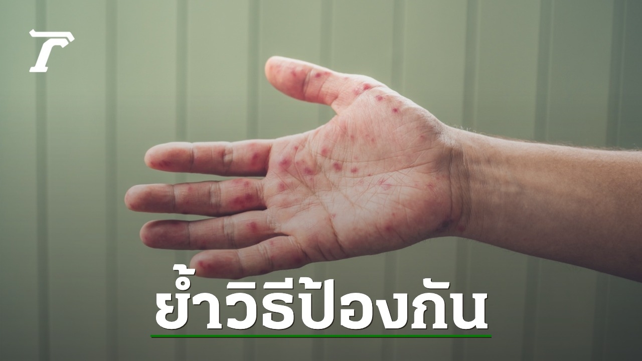 Warning about “Hand, Foot and Mouth” disease, an epidemic that comes with the rainy season, along with advice on how to prevent it.