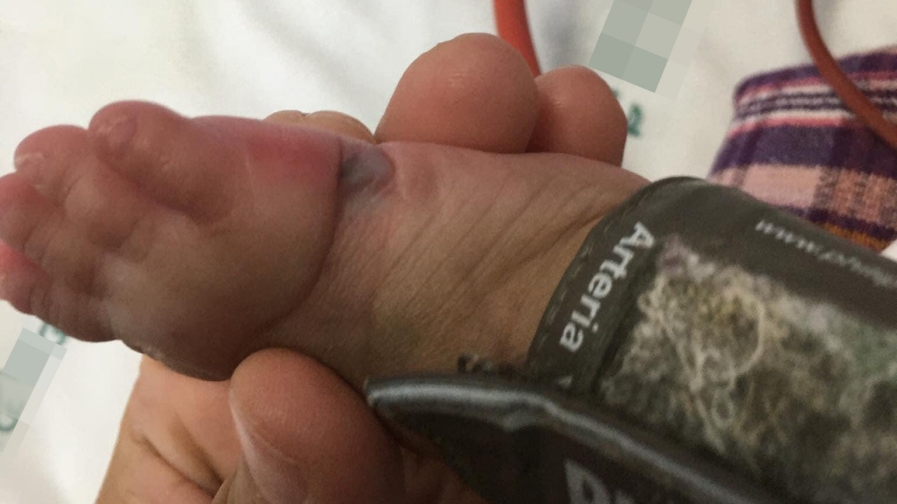 รัดแน่นไปไหม ตั้งคำถาม รพ. ใช้สายวัดชีพจรที่เท้าเด็ก 6 เดือน จนเป็นรอยช้ำ