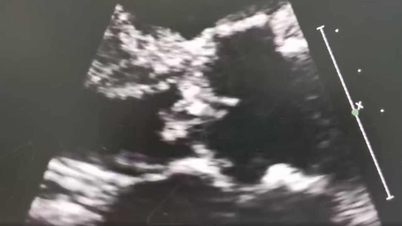 ไม่ใช่เรื่องเล่นๆ ผู้ป่วยติดเชื้อ "ไข้หูดับ" ลามถึงลิ้นหัวใจ ต้องใส่ท่อช่วยชีวิต