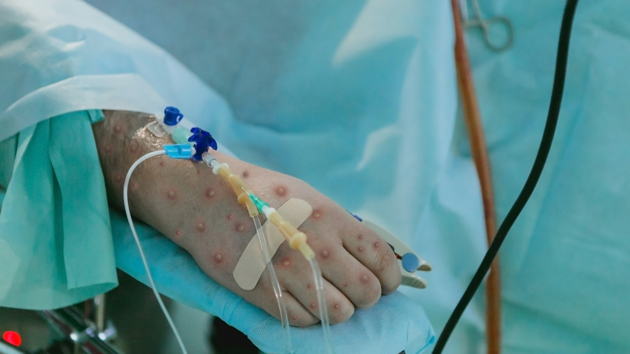 ฝีดาษลิงเพิ่มต่อเนื่อง พบเสียชีวิตรายแรกในไทย ผู้ป่วยใหม่เกือบครึ่งเป็นผู้ติดเชื้อ HIV