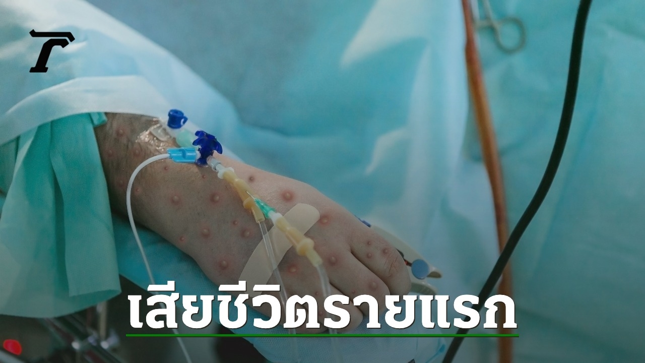 Smallpox Epidemic in Thailand: First Death and High HIV Infection Rate