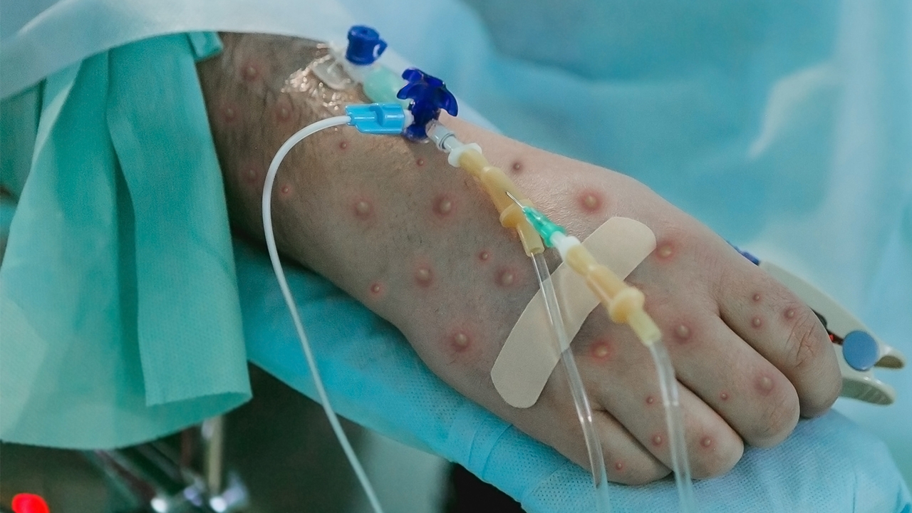 ติดเอดส์-ฝีดาษลิง คนไทยตายรายแรก