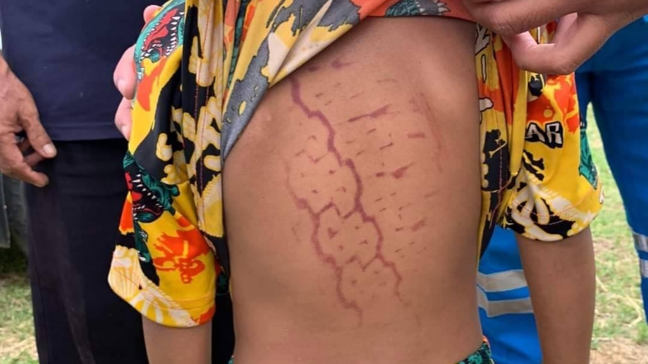 ปลอดภัยแล้ว เด็กชายวัย 5 ขวบ ถูกรถกระบะถอยทับ จนเป็น "รอยล้อ" กลางหลัง