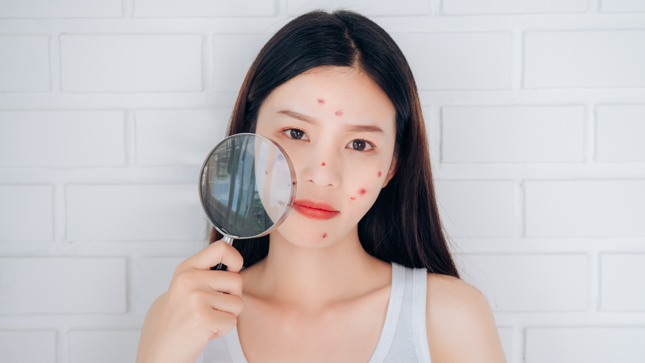 ทำนายฝันว่าสิวขึ้นเต็มหน้า มีความหมายอย่างไร ต้องระวังเรื่องใดบ้าง