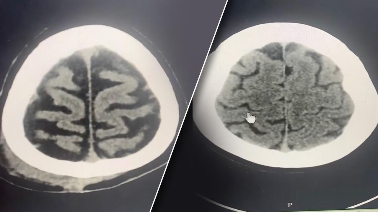 หยุดดื่มได้หรือยัง หมอเทียบภาพสมองคนติดสุรา กับคนทั่วไป เห็นแล้วตกใจ