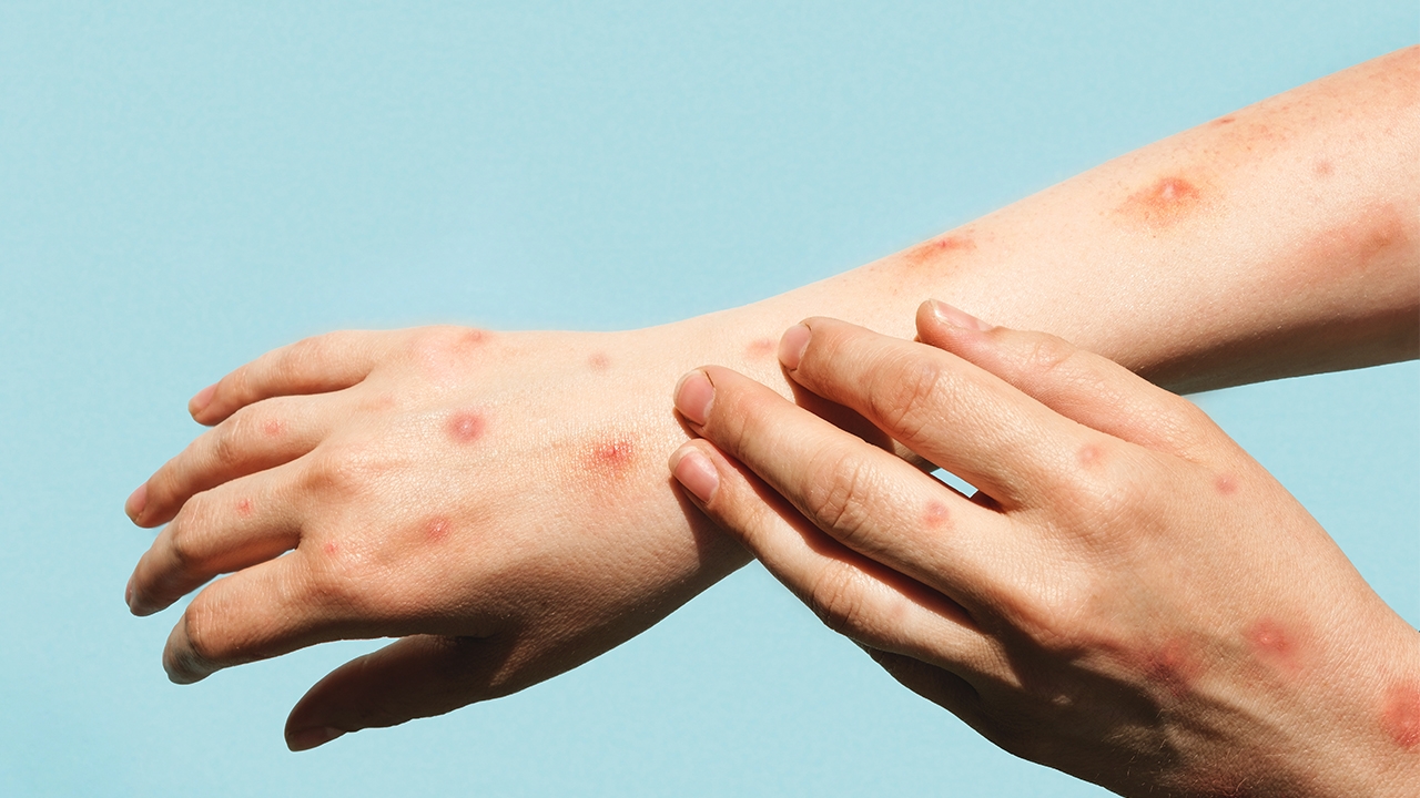 กทม.ฝีดาษลิงพุ่ง เตือนสีแดง นำหน้า 18 จังหวัด ชายรักชาย