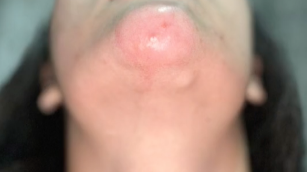 สาวเตือนภัย มือไม่สะอาดอย่าแกะเกา จากจุดเล็กๆ สู่แผลติดเชื้อ ถึงขั้นผ่าตัด