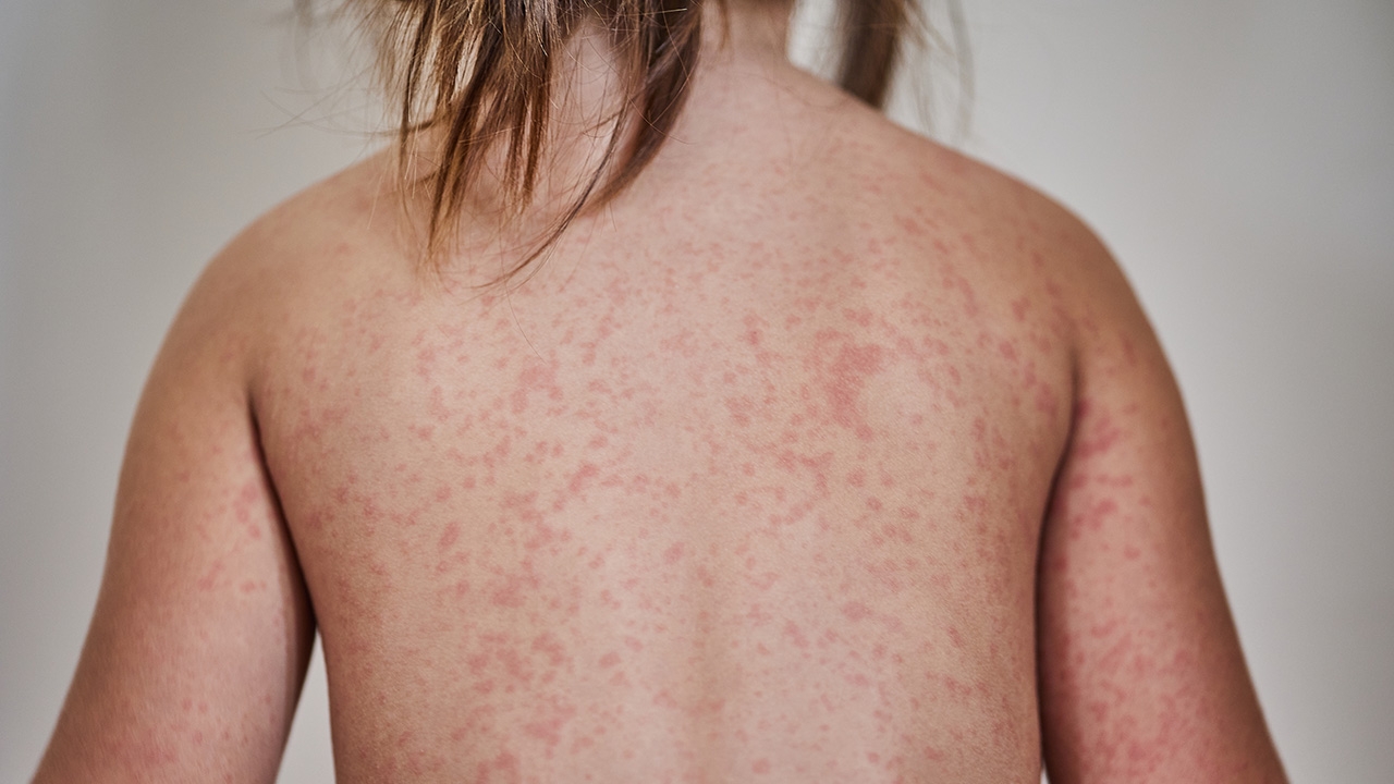 "น้ำเหลืองเสีย" โรคจากไลฟ์สไตล์+ภูมิคุ้มกัน