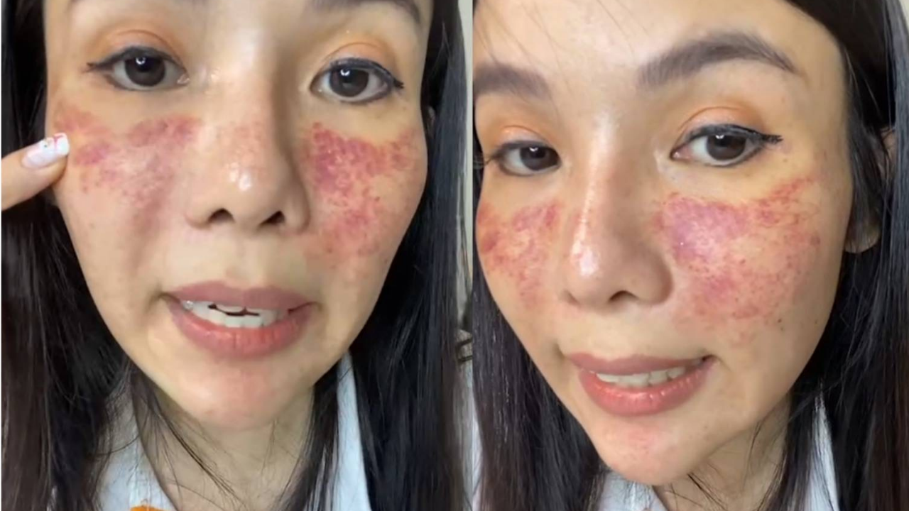 อุทาหรณ์คนอยากสวย บิว อรจิรา เสียโฉมหลังทำเลเซอร์ ถึงขั้นป่วยซึมเศร้า โชคดีรักษาหาย