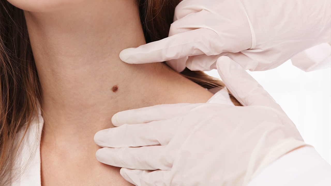 ตำแหน่งไฝ บอกความหมาย หมอช้าง เผยตำแหน่ง งานหนัก แบกภาระและความกดดัน