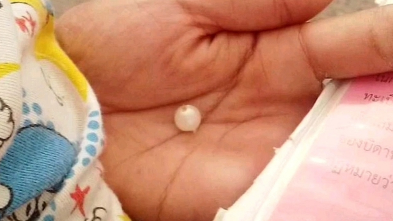 สุดอันตราย เด็กหญิงวัย 2 ขวบ ยัด "ลูกปัด" เข้ารูจมูก ต้องส่งตัวไปโรงพยาบาล