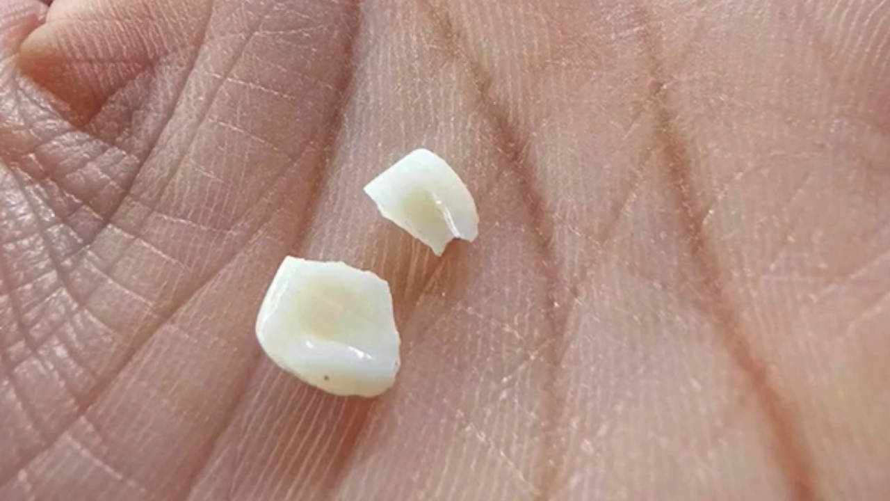 สาวสุดซวย ร่วมขบวนแห่นาค ถูกเหรียญโปรยทานกระเด็นใส่จน "ฟันหัก" บอกบุญมาไวมาก