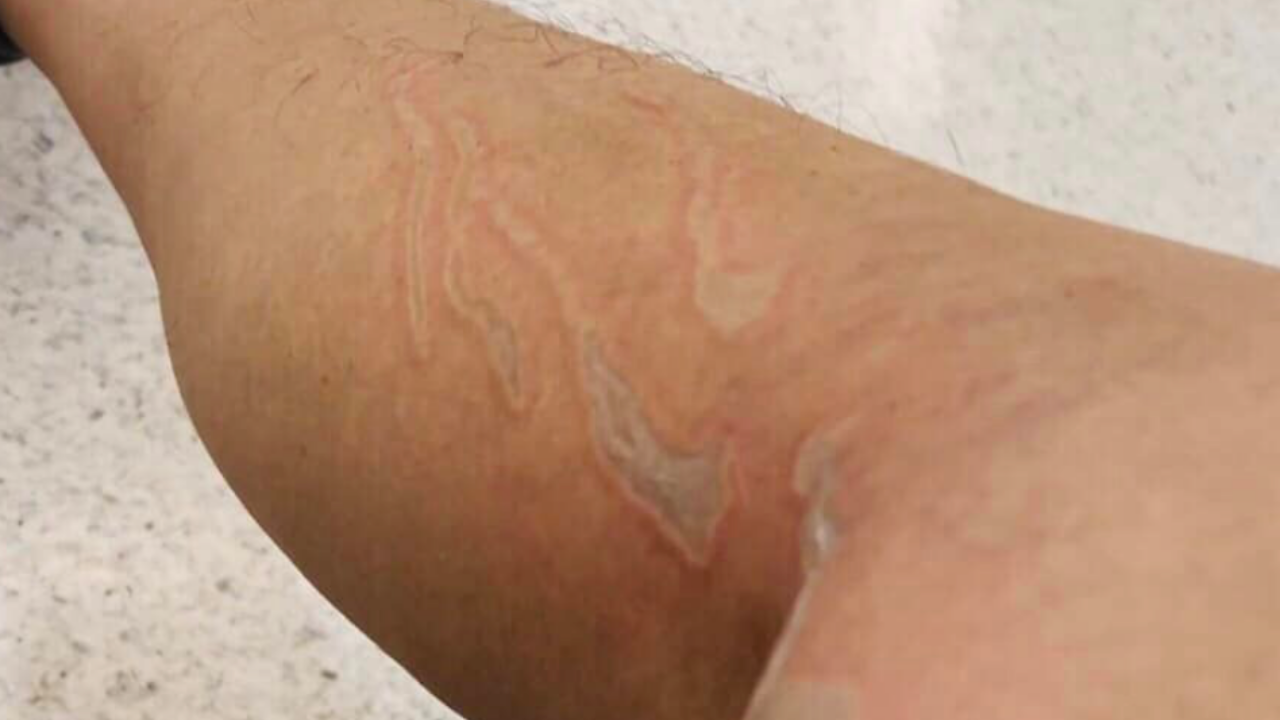 เตือนอุทาหรณ์การใช้ "น้ำยาล้างท่อตัน" กระเด็นใส่ผิวจนเป็นแผลไหม้