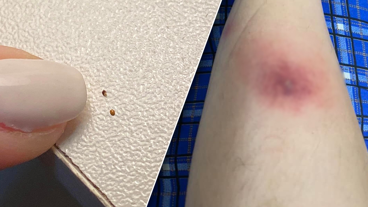 วอนผู้รู้ช่วยตอบ สาวถูกสัตว์ปริศนากัดขา เกิดตุ่มแดงคัน เกาจนเป็นแผลใหญ่