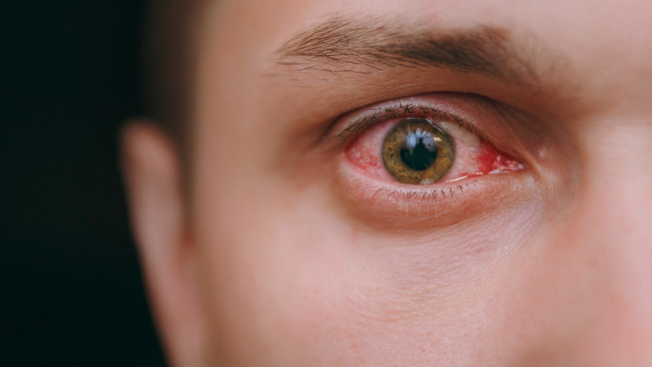 เช็กอาการ "เบาหวานขึ้นตา" รู้เร็ว รักษาไว ลดความเสี่ยงสูญเสียการมองเห็น