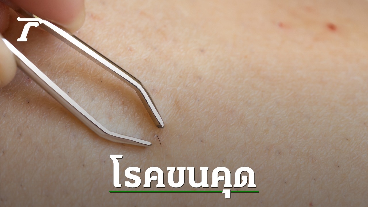 What Is Ingrown Hair? Recommended Methods For Treating Ingrown Hairs 