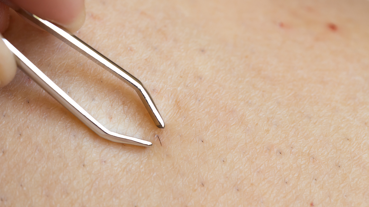 ขนคุดคืออะไร แนะนำวิธีรักษาขนคุด เปลี่ยนผิวหยาบกร้านให้เรียบสวย