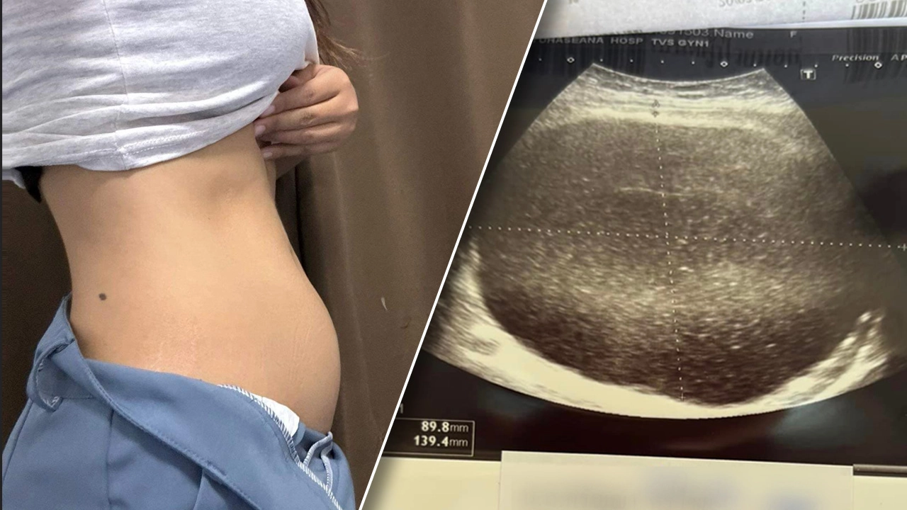 สาวเล่าอุทาหรณ์ ไม่กล้าตรวจภายใน สุดท้ายพบก้อนเนื้อขนาดใหญ่ 17 ซม.