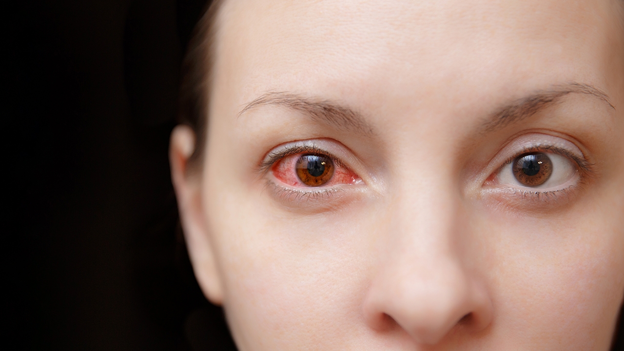 “ตาแดง” โรคใกล้ตัวที่ไม่ควรมองข้าม สาเหตุ อาการ และวิธีป้องกัน