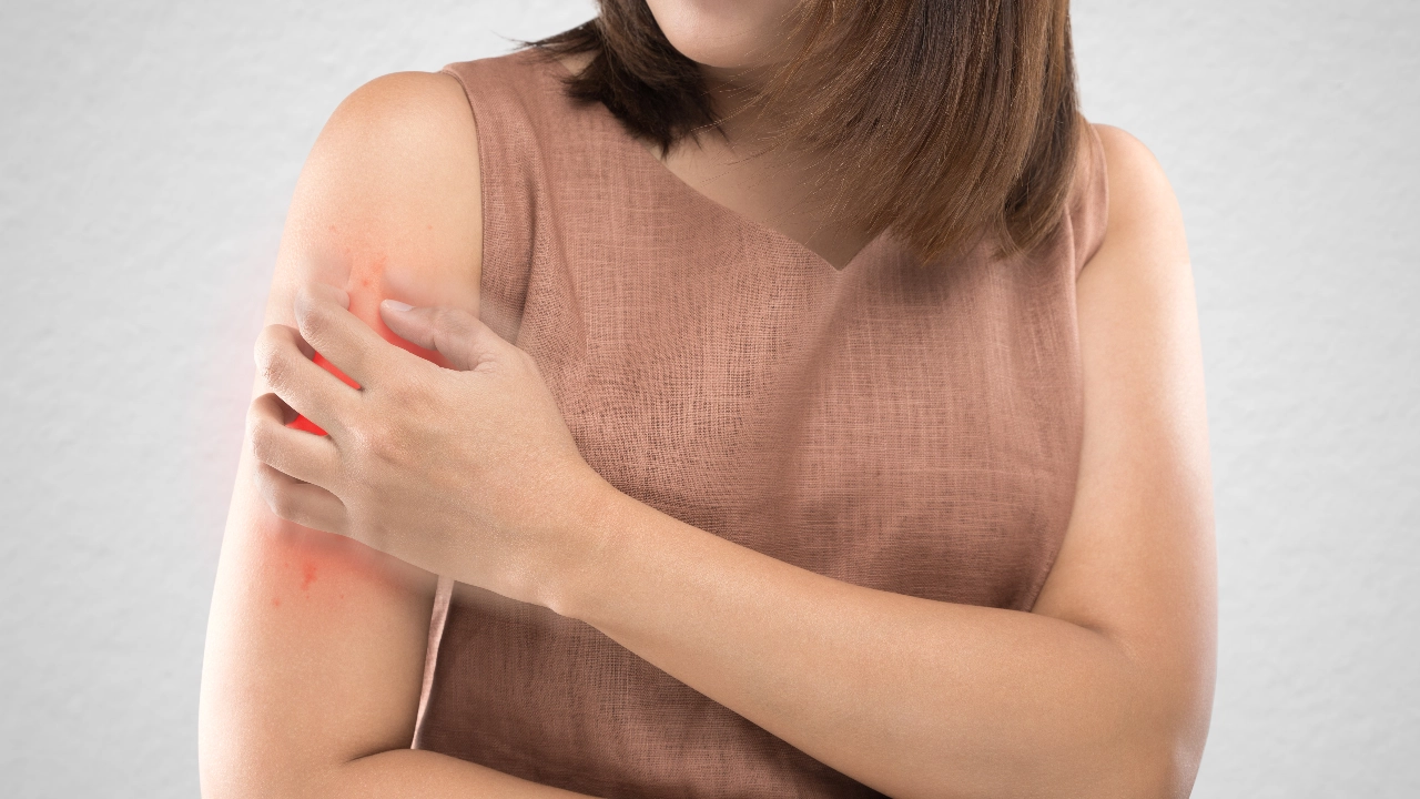 “ผดร้อน” โรคผิวหนังกวนใจ รู้ทันอาการ และวิธีรักษาทั้งในเด็กและผู้ใหญ่