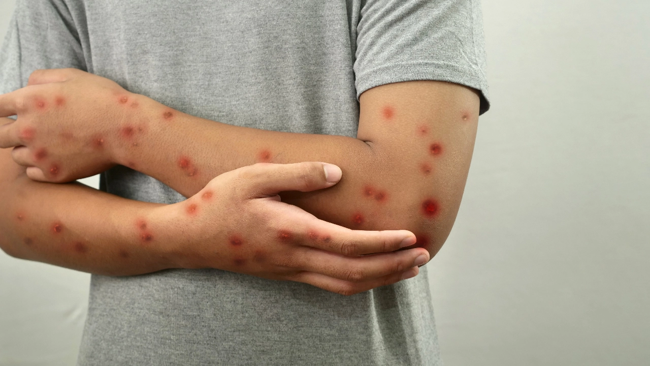 เช็กอาการ โรคหัด ติดต่ออย่างไร ป้องกันได้หรือไม่