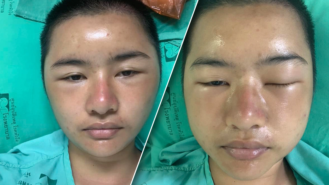 รองผบช.น. สั่งดูแล ส.ต.ต.หญิงฝึกกองร้อยน้ำหวาน ถูกทำโทษจนป่วย  