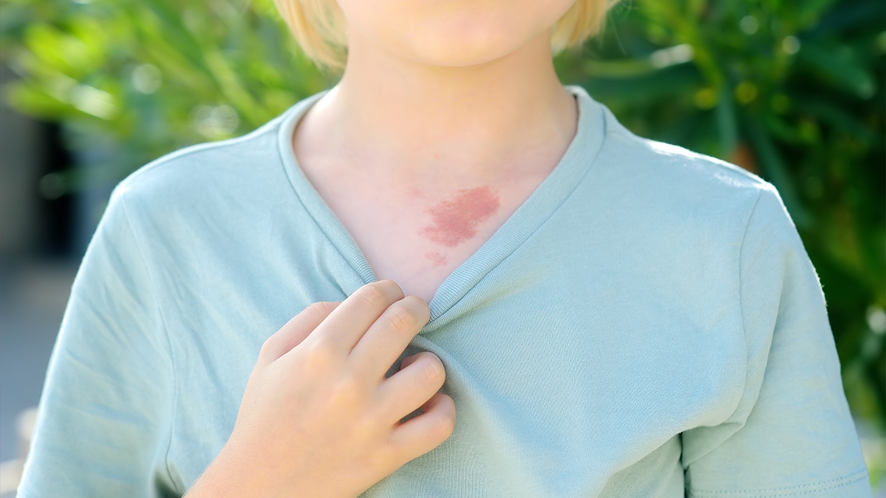 ทำนายตำแหน่งปานดำ ปานแดง ปานจุดไหนบอกวาสนา โชคลาภร่ำรวย หรืออาภัพรัก