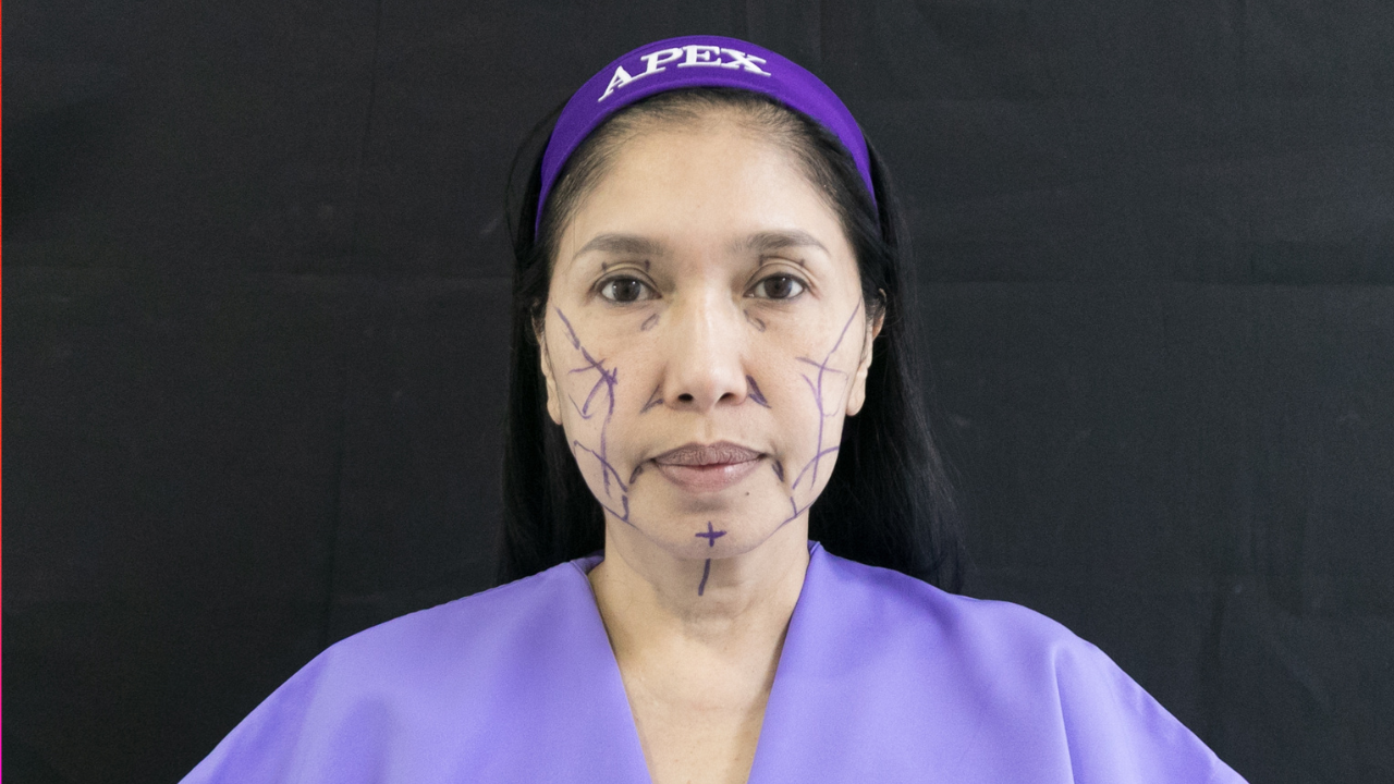 สวนกระแสดราม่า เอ้ ชุติมา ทำศัลยกรรมชุดใหญ่ 5 จุด 9 วันสวยทันใจรับงานได้ทันที