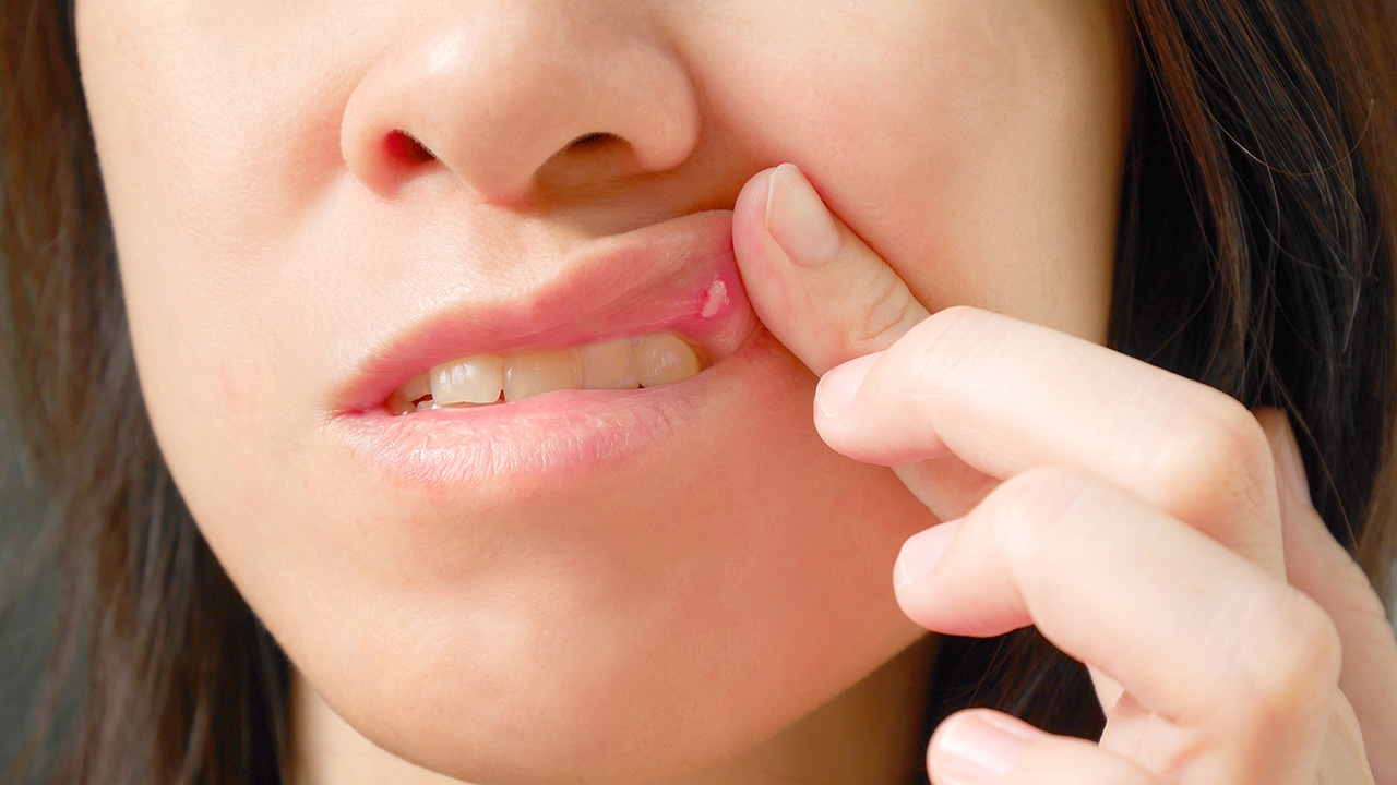 "แผลร้อนใน" ใครๆ ก็เป็นได้